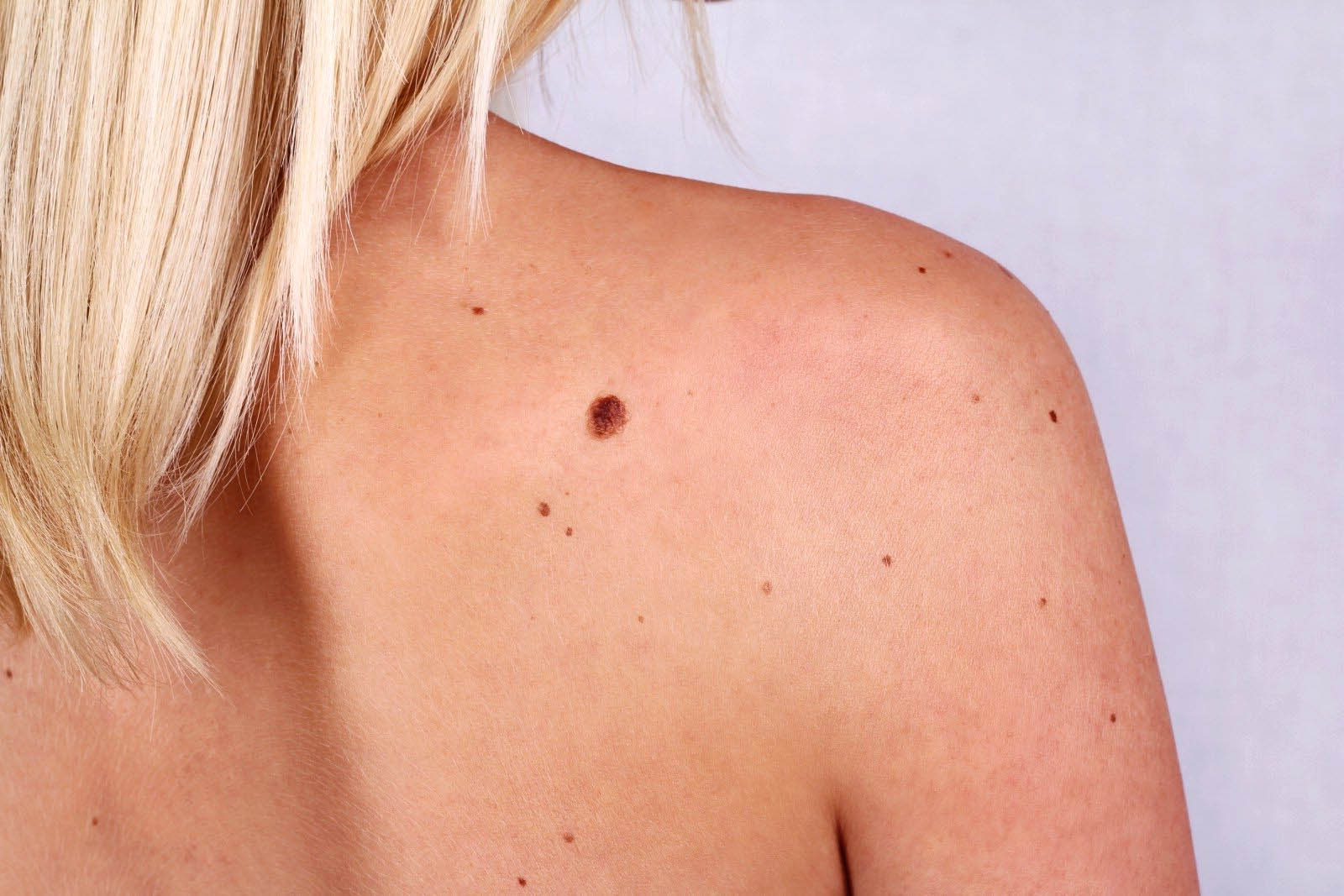 МОЗ затвердило клінічний протокол «Базальноклітинний рак шкіри»