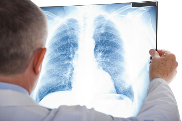 Із 10 травня діє оновлений порядок виявлення та діагностики туберкульозу