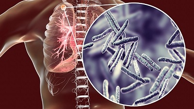 МОЗ пропонує залучити до епіднагляду за туберкульозом сімейних лікарів