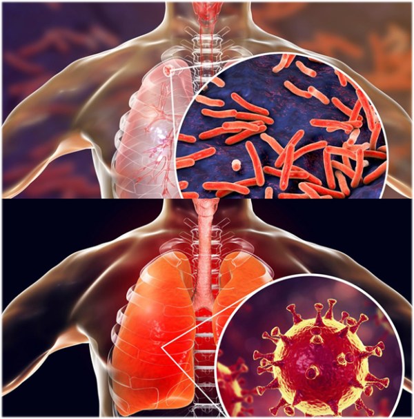 Як розрізнити туберкульоз і COVID-19: роз’яснення МОЗ