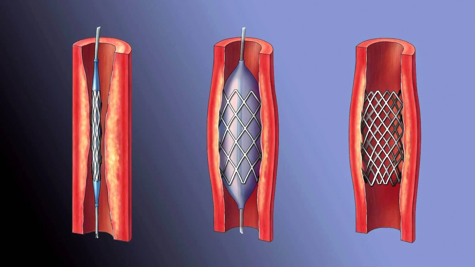 При оплаті планового стентування не враховується кількість поставлених одному пацієнту стентів — голова НСЗУ Наталія Гусак
