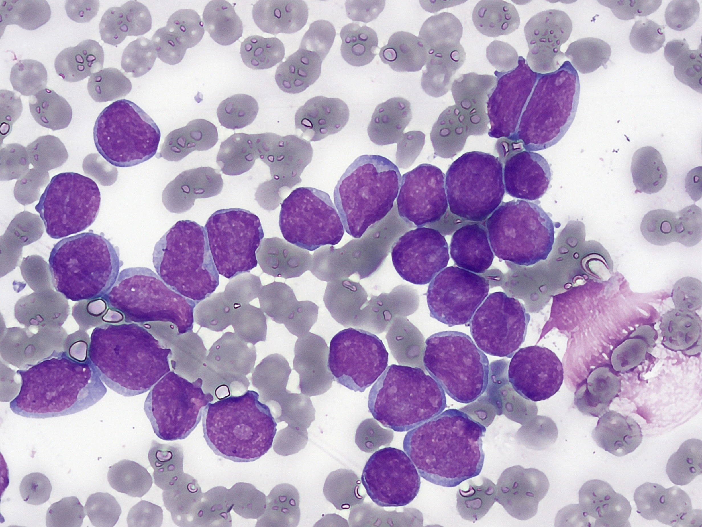 МОЗ затвердило Стандарт медичної допомоги при гострому лімфобластному лейкозі у дітей