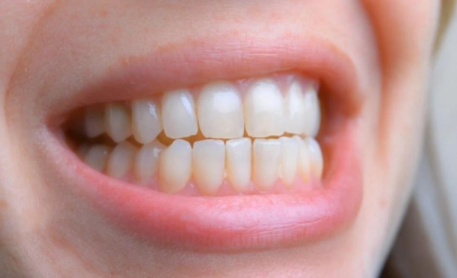 МОЗ затвердило два нові стандарти медичної допомоги щодо терапії пульпи