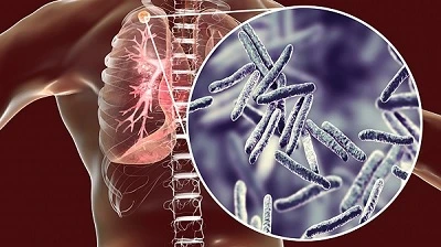 МОЗ пропонує залучити до епіднагляду за туберкульозом сімейних лікарів МОЗ пропонує залучити до епіднагляду за туберкульозом сімейних лікарів