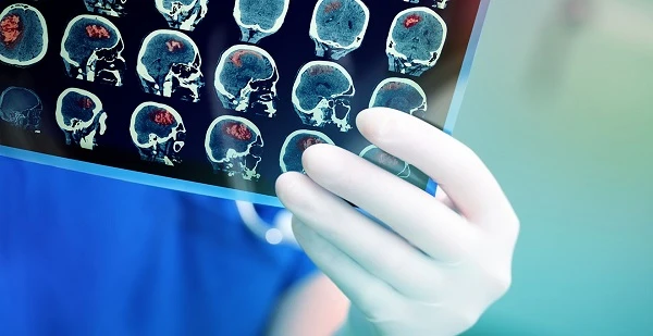 Тариф за пакетом із лікування інсульту буде диверсифікований і сягатиме 99 тис. грн Тариф за пакетом із лікування інсульту буде диверсифікований і сягатиме 99 тис. грн