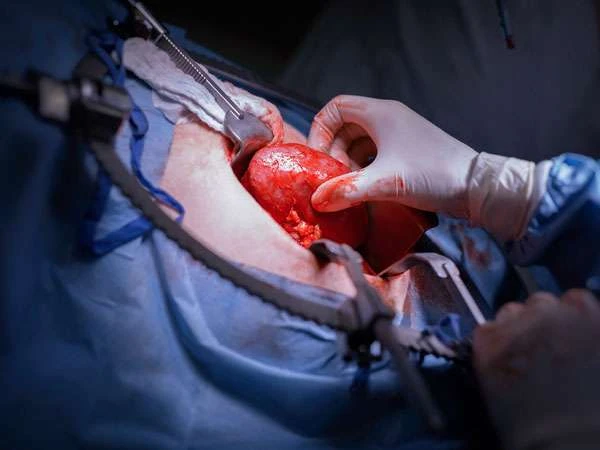 МОЗ розробило вимоги до виготовлення, контролю якості та обігу біоімплантатів МОЗ розробило вимоги до виготовлення, контролю якості та обігу біоімплантатів